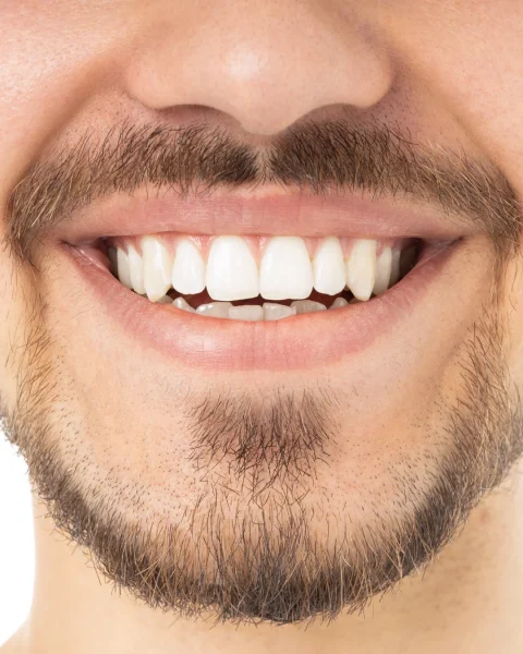 Close-up of a smiling man showing white teeth with a mustache and beard visible around the mouth.