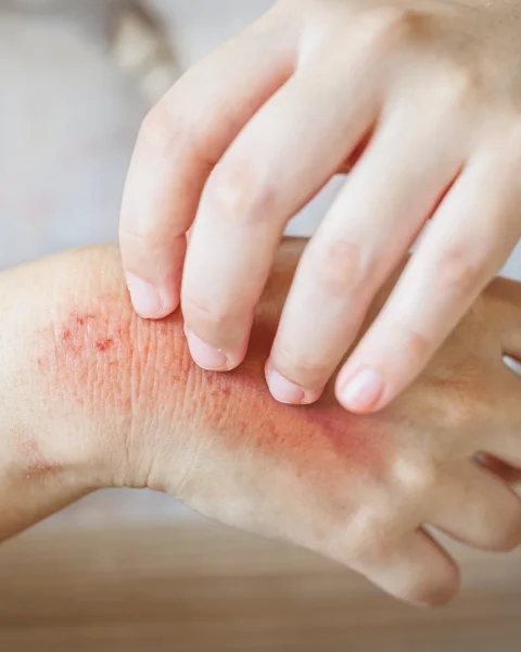 Close-up of a reddened, irritated wrist with small scratches, being touched by fingers.