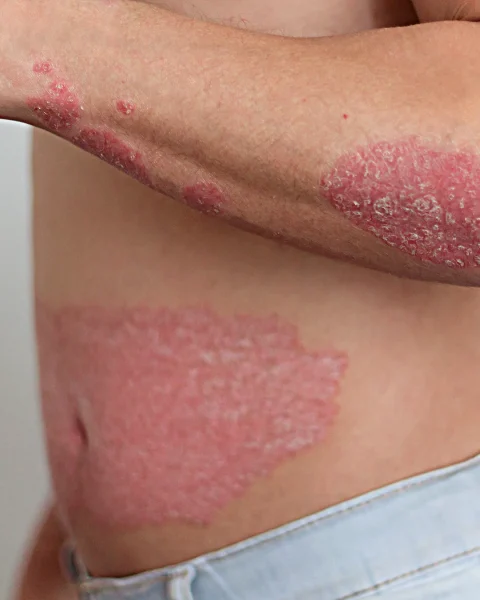 Close-up of a person's neck with large red, scaly patches and peeling skin, likely a dermatitis or psoriasis-type rash.