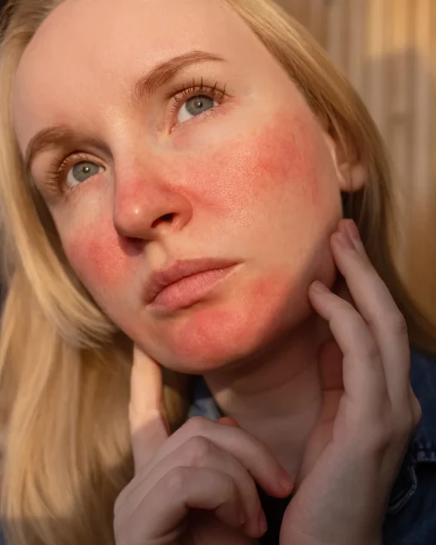 Close-up of a woman with flushed red cheeks, touching her jawline with her fingers.